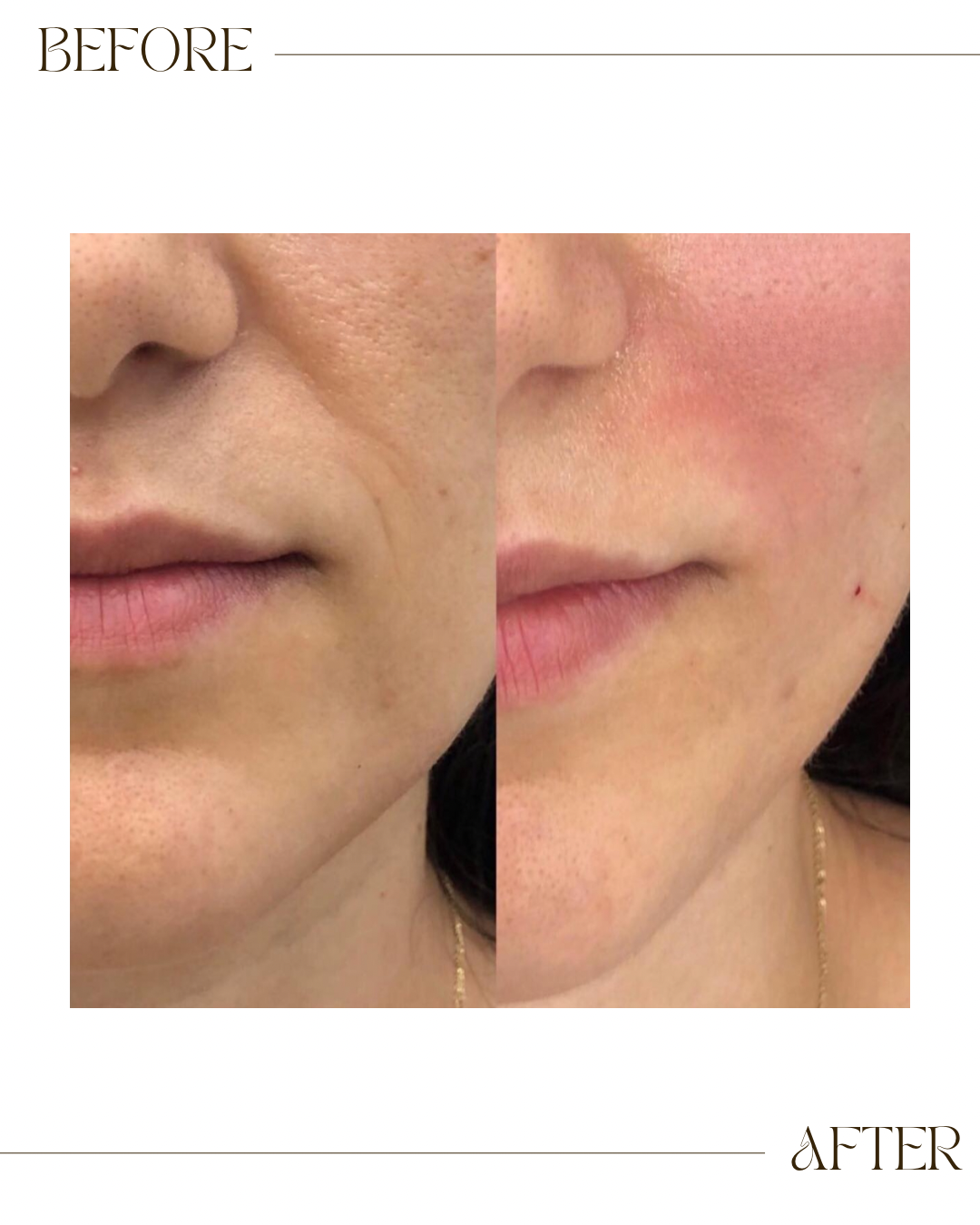 Skin Booster Injections 