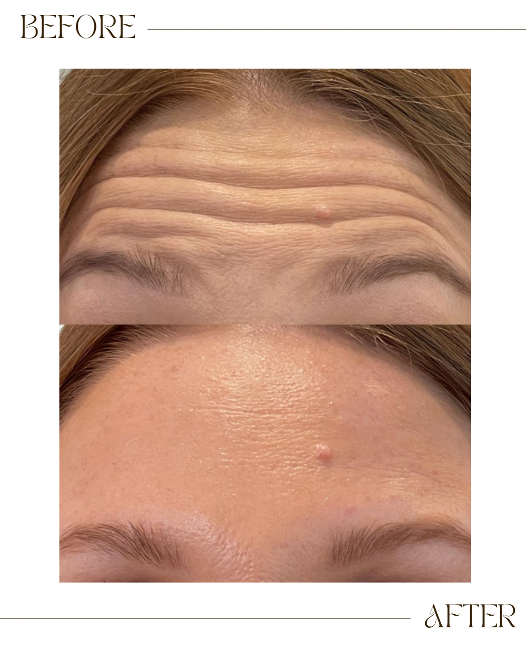 Anti Wrinkle Botox 