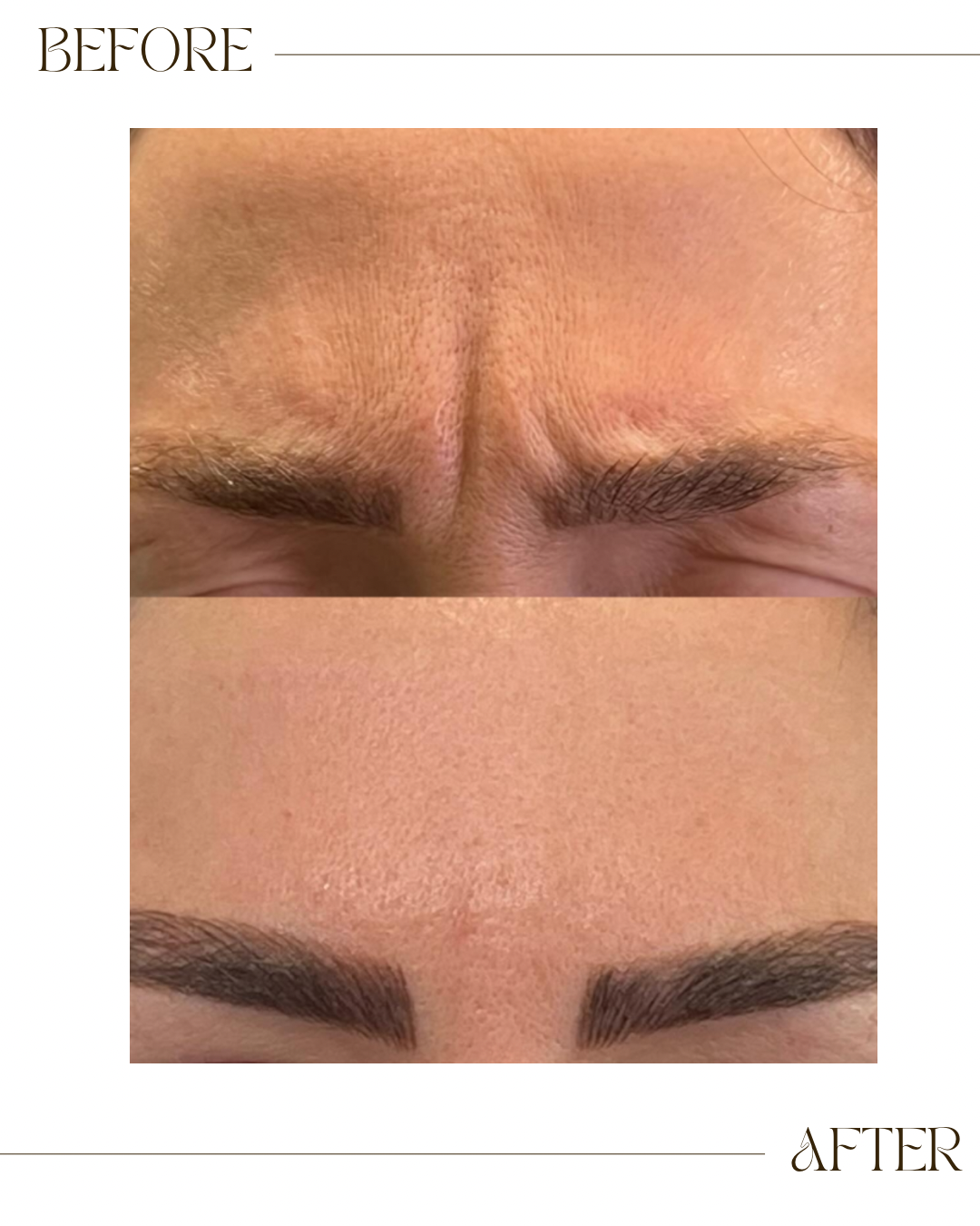 Botox 
