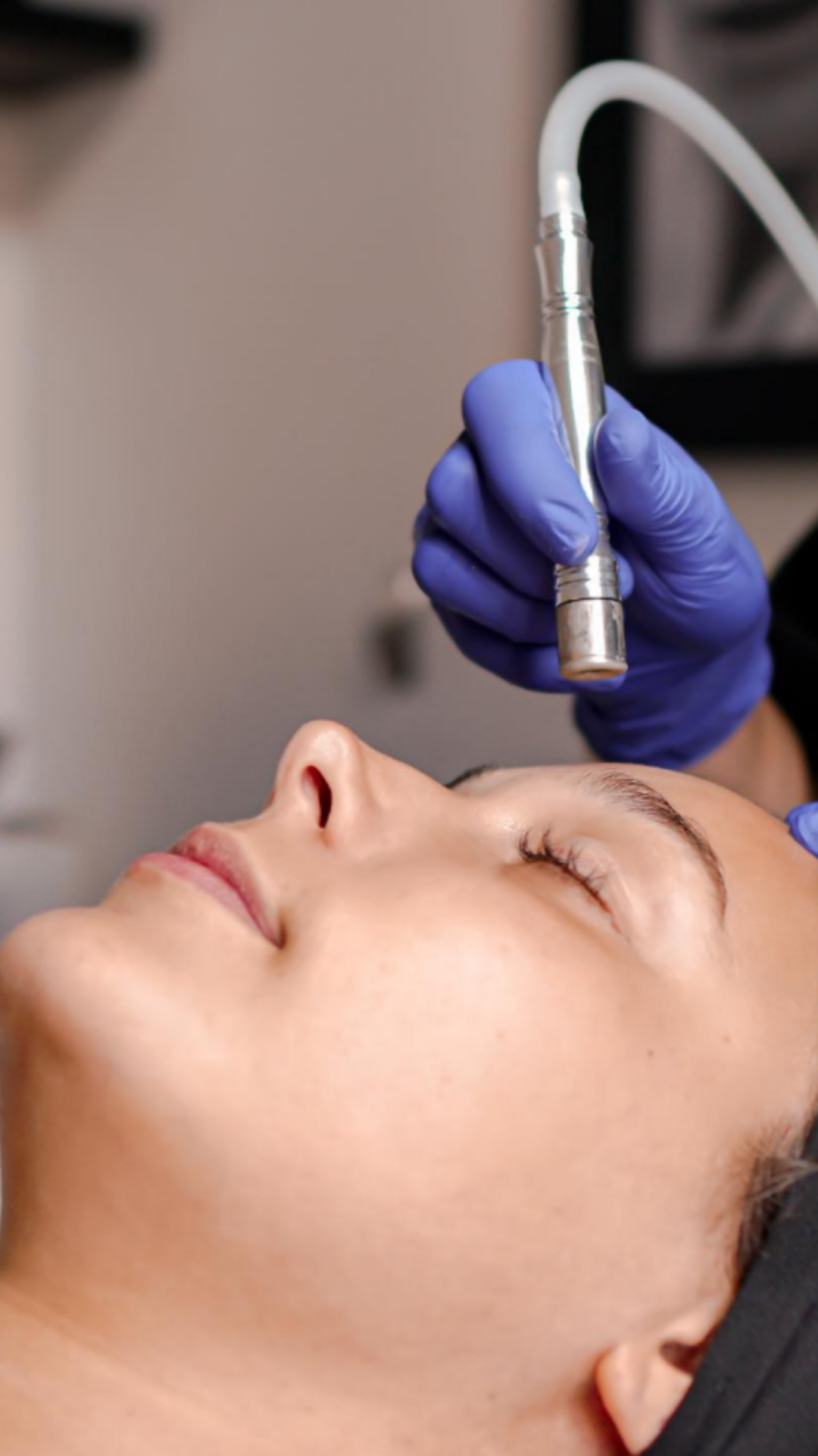 Microneedling
