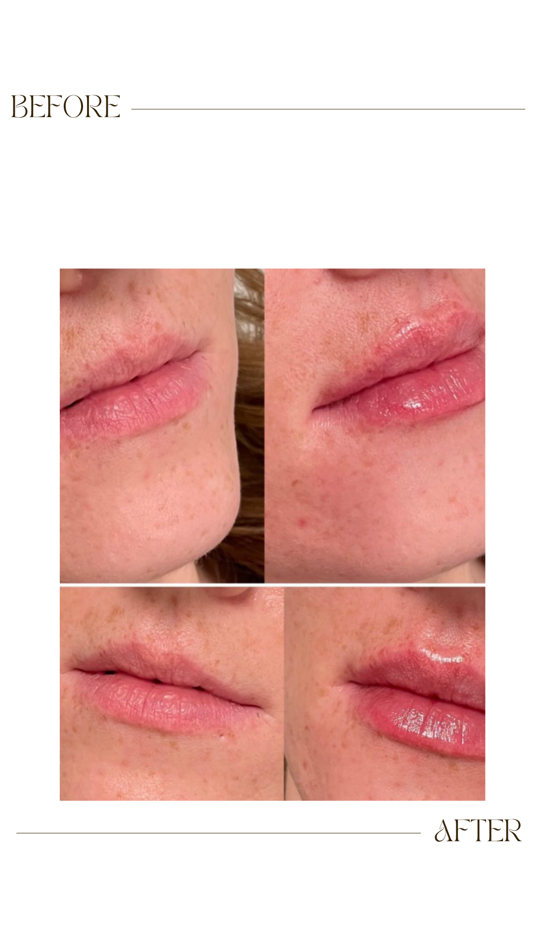 Dermal Fillers