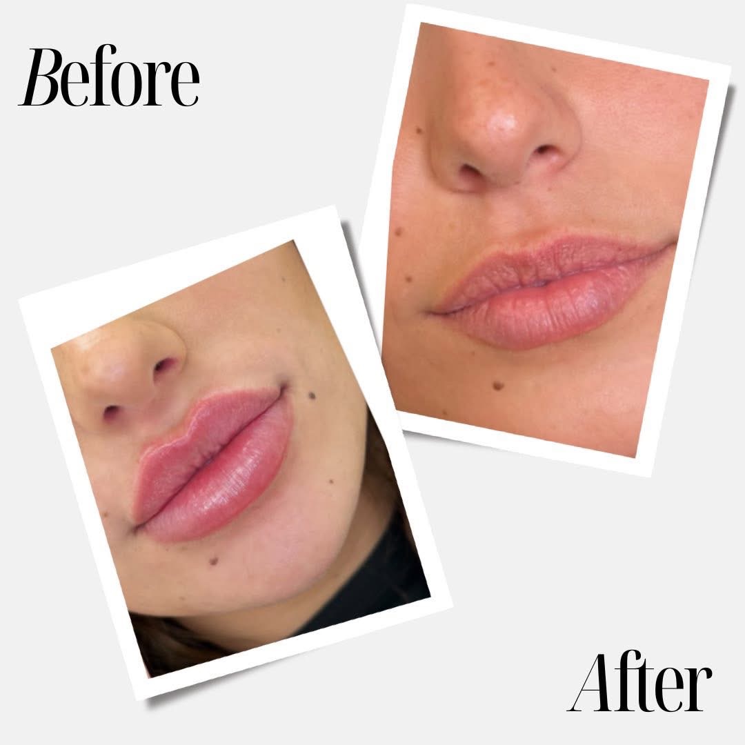 Dermal Fillers & Lip Fillers 